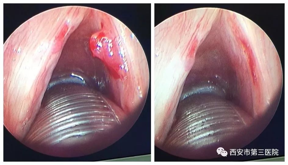 (声带息肉术前术后)