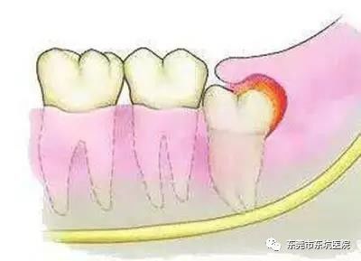 这一种类型的智齿,通常是埋在牙槽骨里面的,如果会自主疼痛,或者发现