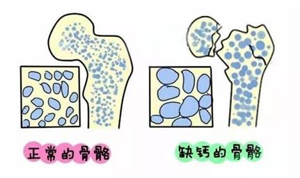 骨关节疼痛或轻微外伤后骨折也应及时就诊以排除继发性骨质疏松或特发