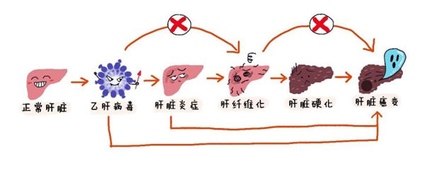 纤维化?难道我的肝脏像一团乱麻?