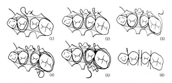 锚式缝合锚式缝合是将最后一个磨牙远中的龈瓣或缺牙间隙处的龈瓣以锚