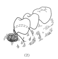 牙医技巧口内缝合术