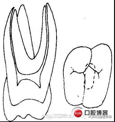 碎屑和残渣都必须清理干净, 去除薄壁弱尖 各牙开髓要点 下颌磨牙