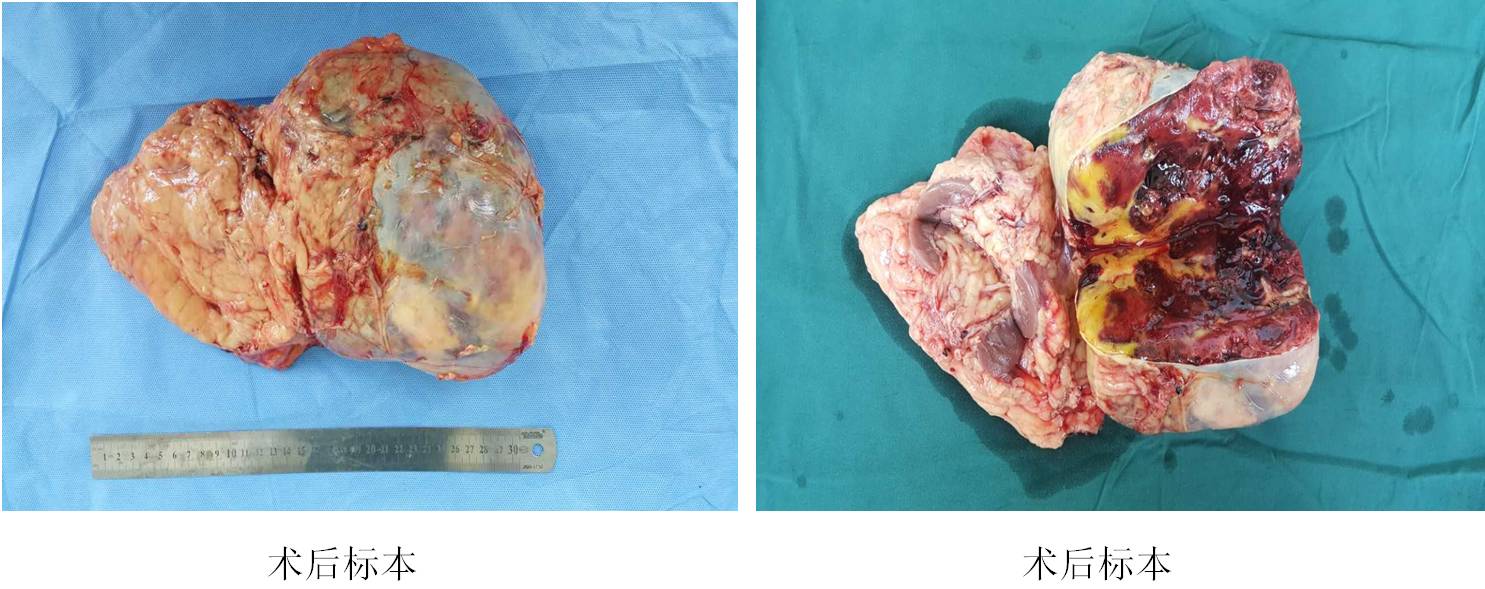 复杂腹膜后肿瘤联合腹腔多脏器及血管切除重建手术病例分享