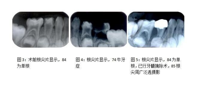 下颌第一乳磨牙单根管病例