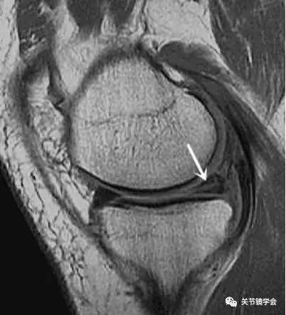 详解半月板损伤的机制,诊断及治疗