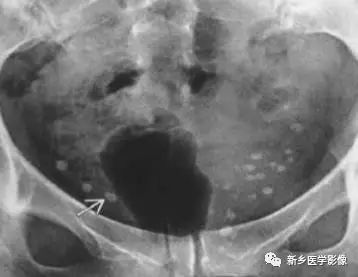 输精管钙化9主要位于盆腔内,表现为不均一的点状钙化.