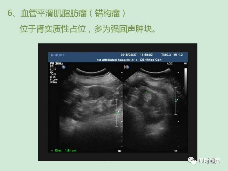 肾结石超声诊断及鉴别