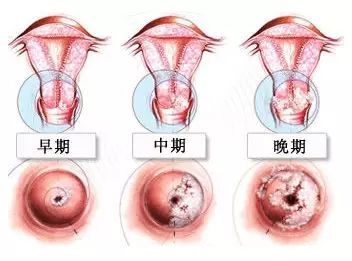 2分钟看懂宫颈癌,终身受益!