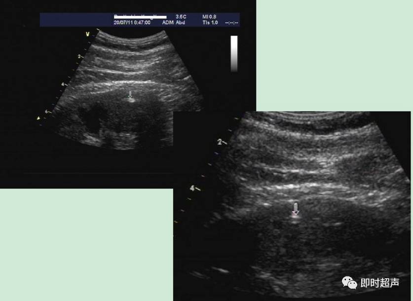 肾结石超声诊断及鉴别
