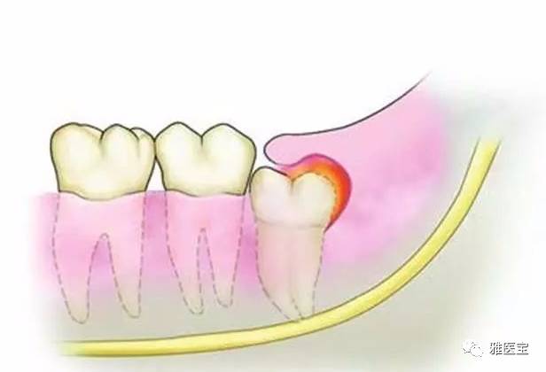 临床表现:第三磨牙的红肿,可有咀嚼和吞咽困难,张口受限,下颌淋巴结
