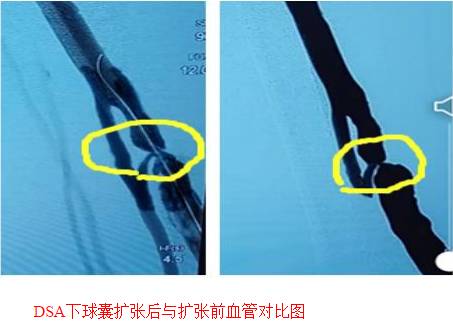 介入下的动静脉内瘘球囊扩张术