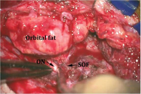 蝶骨嵴中外侧脑膜瘤手术技巧 the neurosurgical atlas全文翻译