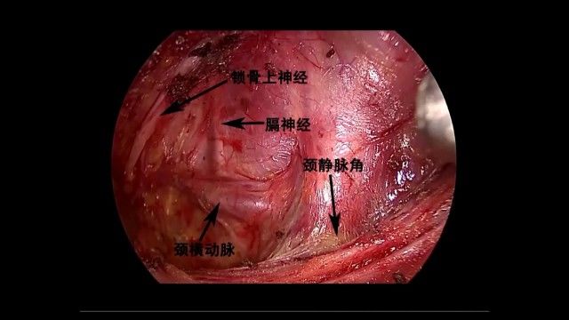 同时术中神经监测设备的应用也可以最大限度的降低喉返神经损伤的概率