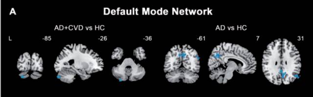 文献阅读脑血管疾病对阿尔茨海默病患者脑网络的影响
