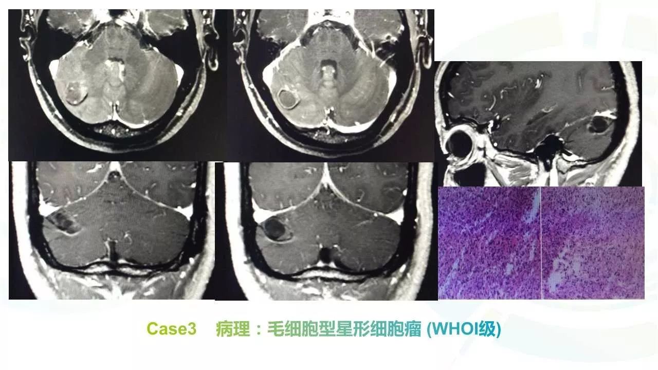 毛细胞星形细胞瘤