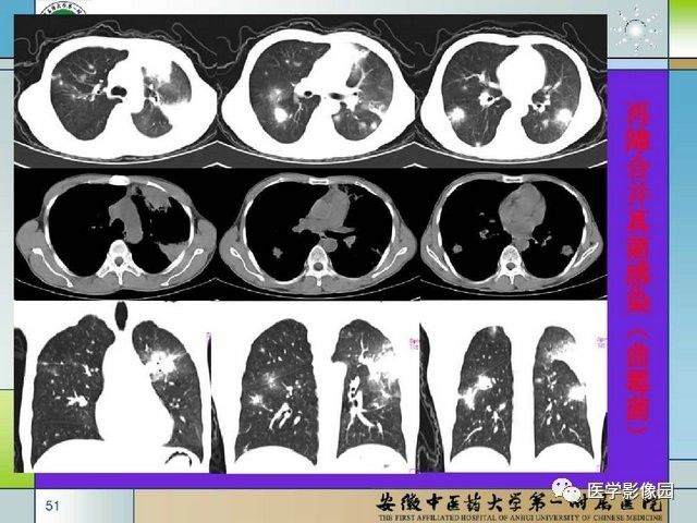 肺部感染性疾病的ct表现分析丨影像天地