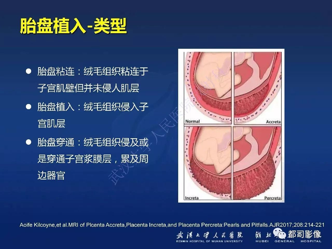 胎盘植入和前置胎盘mr诊断