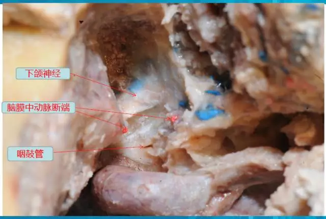 颞下窝入路b型解剖