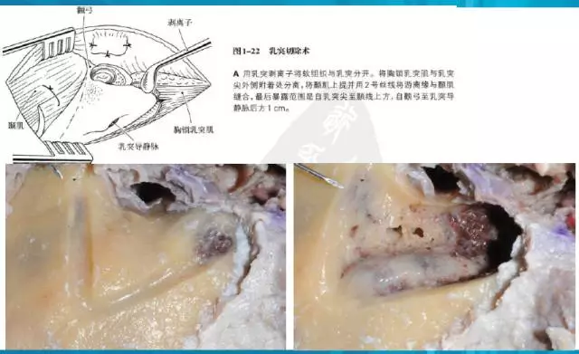 颞下窝入路b型解剖