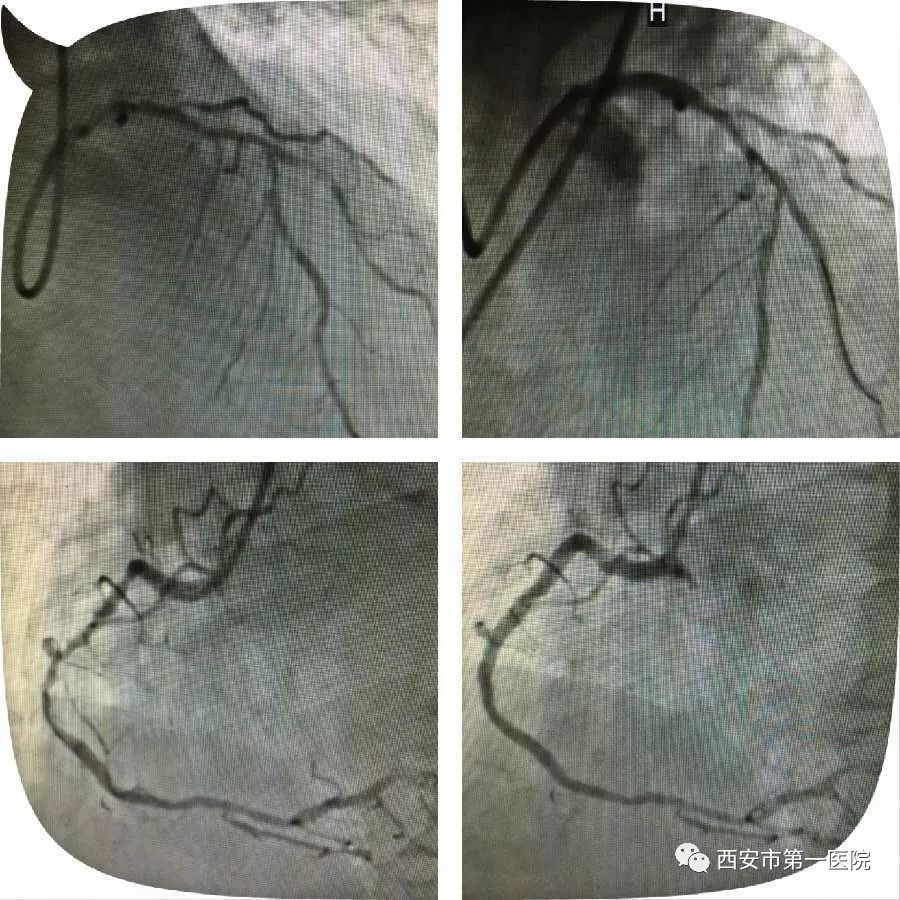 西安市第一医院心血管病医院应用切割球囊成功完成1例