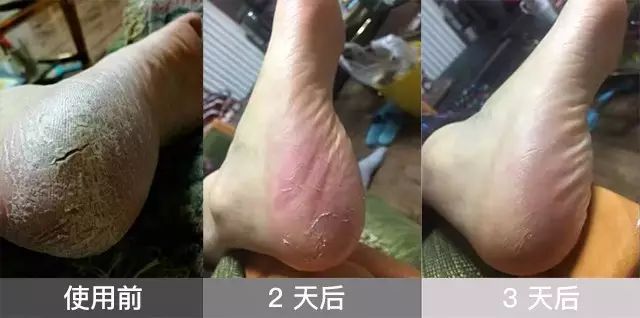 入秋手脚脱皮怎么办