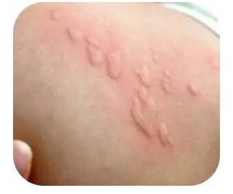 这是一种很常见的过敏性皮肤病——荨麻疹,不仅成人发病多,在婴幼儿