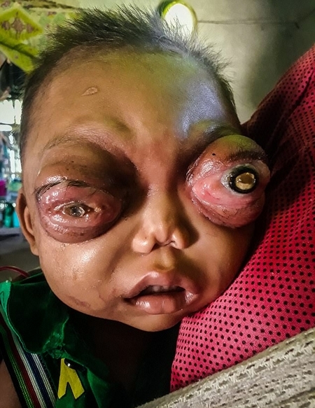印2岁男童患罕见眼癌 眼球外凸似外星怪物