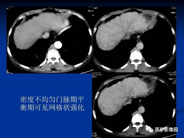 肝脏ct的阅片方法丨影像天地
