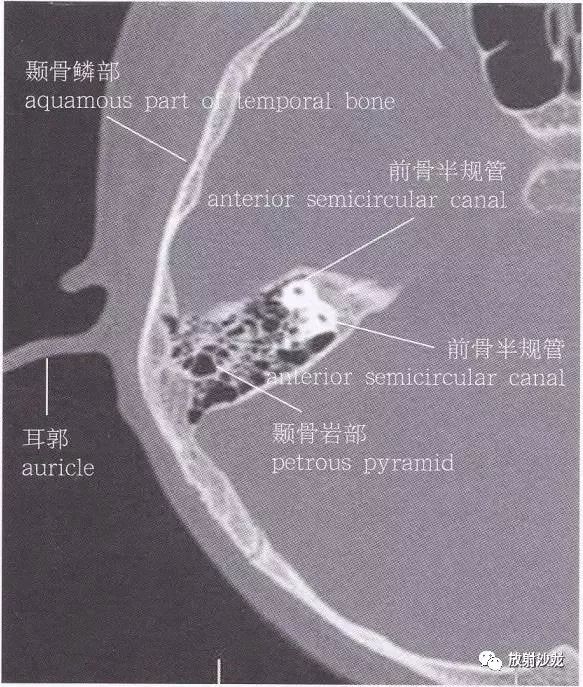 【解剖】颞骨大体解剖 轴位及冠状位ct断层图像