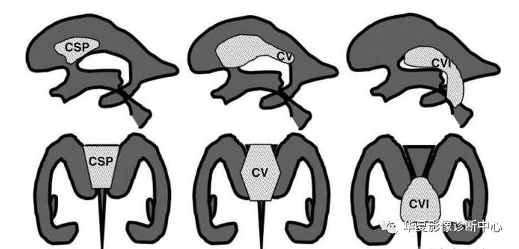 【影像基础】第五,第六脑室属于脑室系统吗?