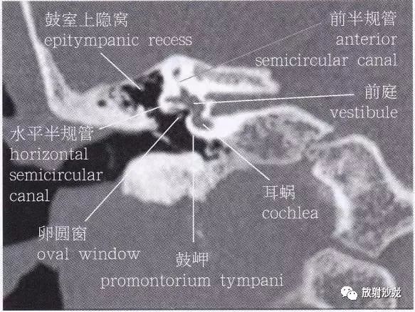 【解剖】颞骨大体解剖 轴位及冠状位ct断层图像