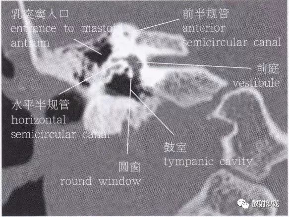 【解剖】颞骨大体解剖 轴位及冠状位ct断层图像