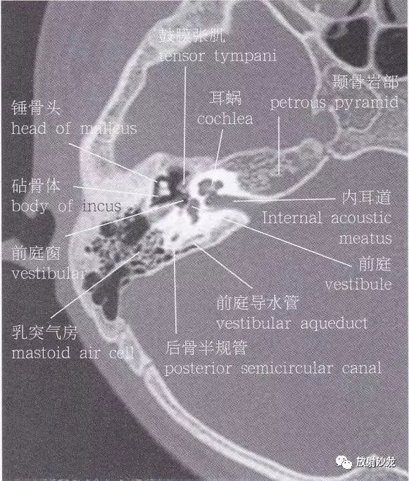 【解剖】颞骨大体解剖 轴位及冠状位ct断层图像