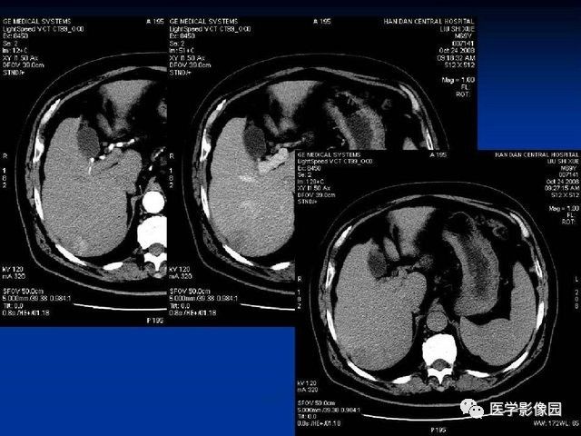 肝脏ct的阅片方法丨影像天地