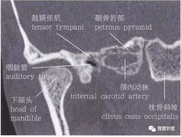 【解剖】颞骨大体解剖 轴位及冠状位ct断层图像