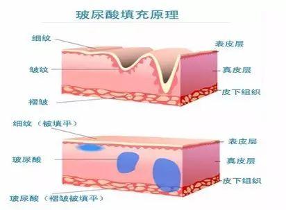 玻尿酸的原理是什么_玻尿酸的原理(2)