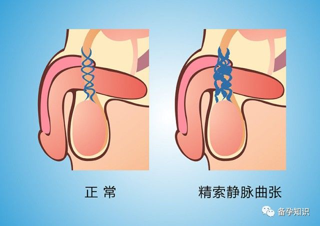 精索静脉曲张最佳手术方式-显微镜精索静脉高位结扎术_东莞东华医院