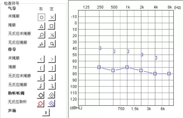 (3)混合性听力损失 如果纯音听阈测定报告显示各频率气导和骨导阈值均