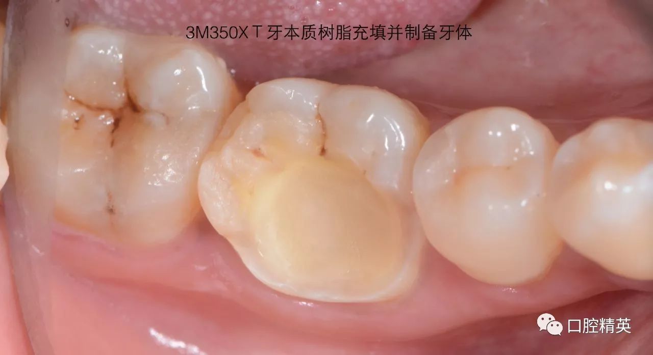 后牙根管再治疗铸瓷嵌体修复
