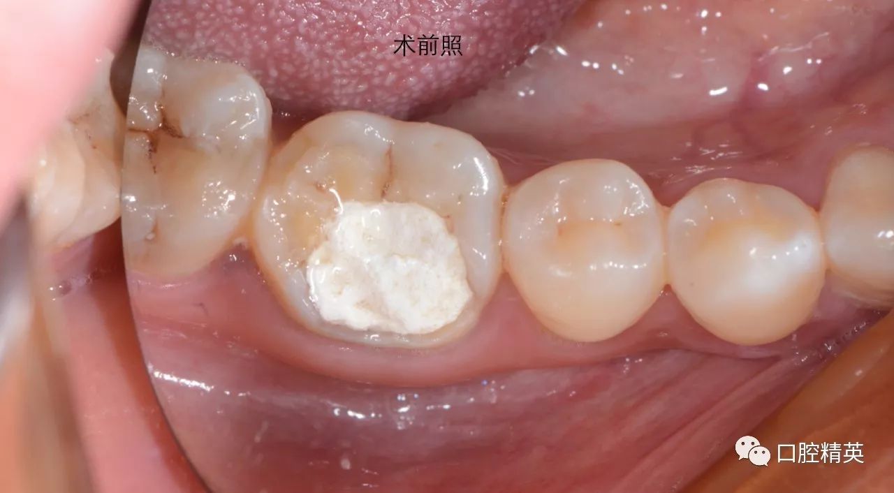 25%氢氟酸蚀铸瓷嵌体  根管在治疗x光片  3m350xt牙本质树脂充填并