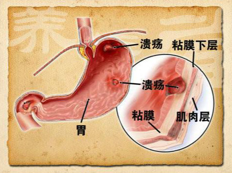 警惕,胃出血可能危及生命!预防和治疗很重要.