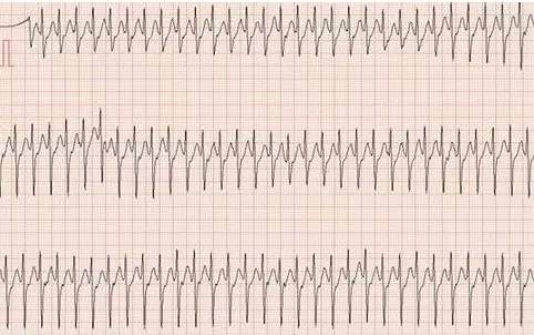 常见心电图危急值识别方案