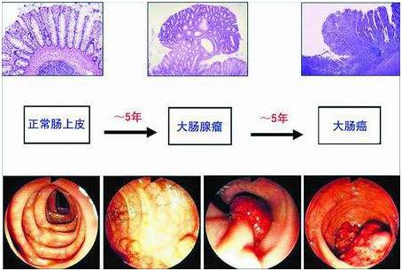 3,大肠腺瘤