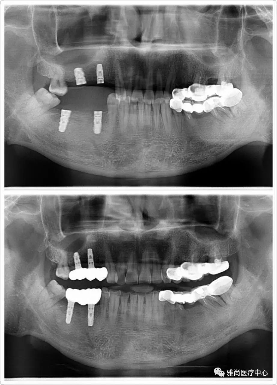 传统镶牙和种植牙的区别详细介绍