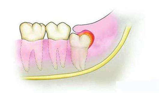 牙齿疼痛的方式有12种之多,那么,你属于哪一种?