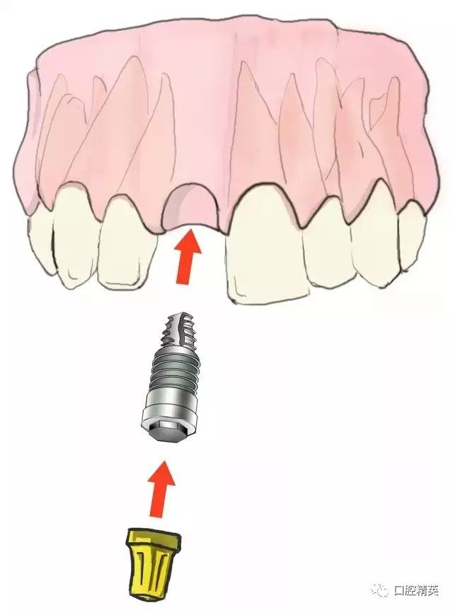 传统镶牙和种植牙的区别详细介绍