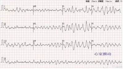 5心室颤动(vf) 心电图特征 qrs-t波群完全消失,出现大小不等,极不匀齐