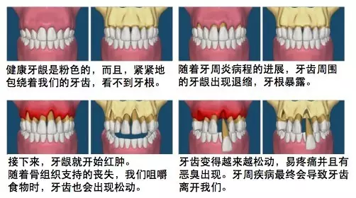 牙周炎在早期通常不会引起疼痛,偶尔的不适常常可自行缓解,到晚期