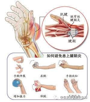 【组图】不要忽视手腕的疼痛——手腕腱鞘炎的预防与锻炼